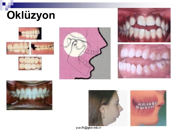 Oklüzyon yusufk@gazi. edu. tr 