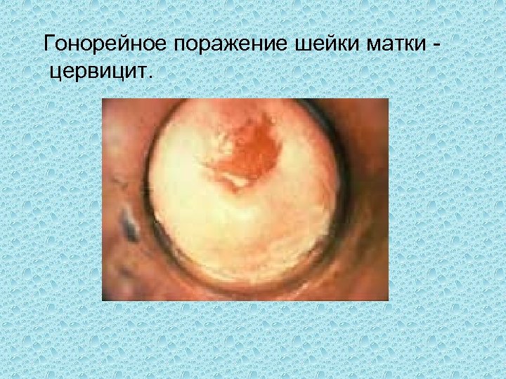  Гонорейное поражение шейки матки цервицит. 