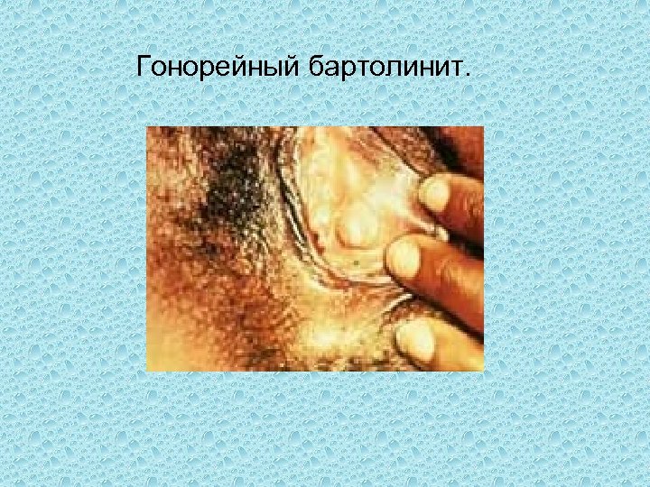  Гонорейный бартолинит. 