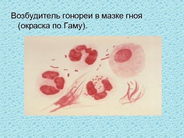 Возбудитель гонореи в мазке гноя (окраска по Гаму). 