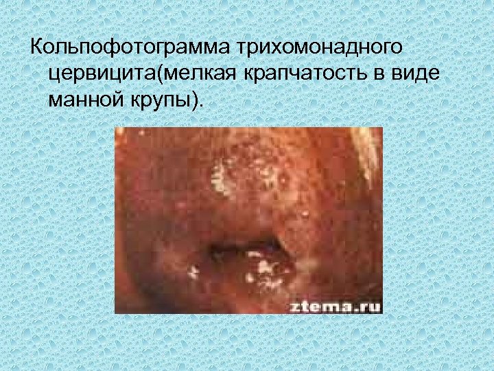 Кольпофотограмма трихомонадного цервицита(мелкая крапчатость в виде манной крупы). 