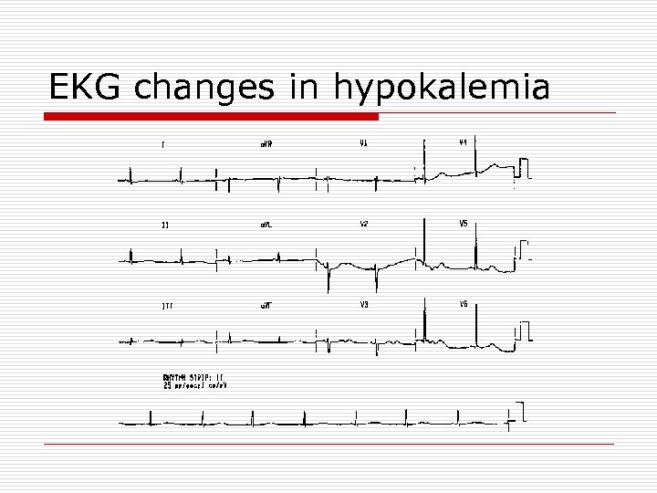 EKG changes in hypokalemia 