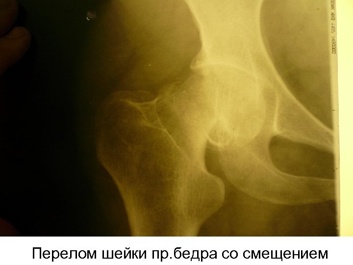 Перелом шейки пр. бедра со смещением 