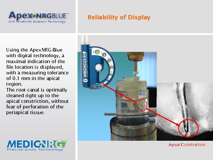 Reliability of Display Using the Apex. NRG-Blue with digital technology, a maximal indication of