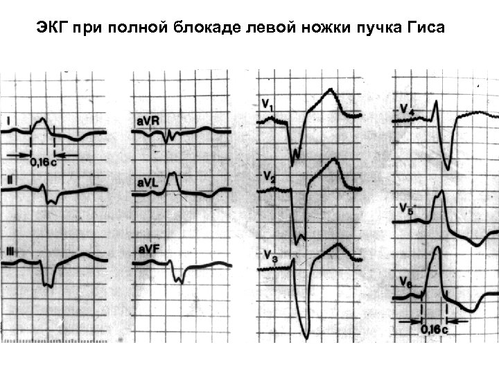ЭКГ при полной блокаде левой ножки пучка Гиса 