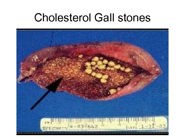 Cholesterol Gall stones 