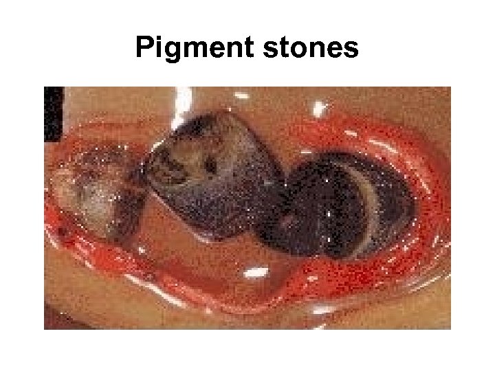 Pigment stones 
