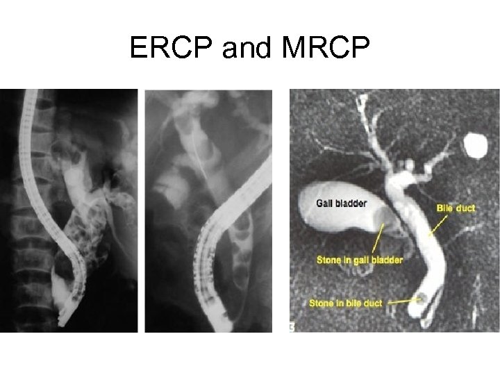 ERCP and MRCP 