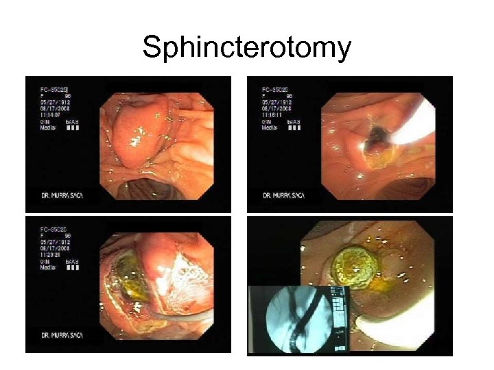Sphincterotomy 