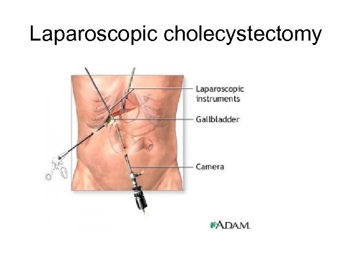 Laparoscopic cholecystectomy 