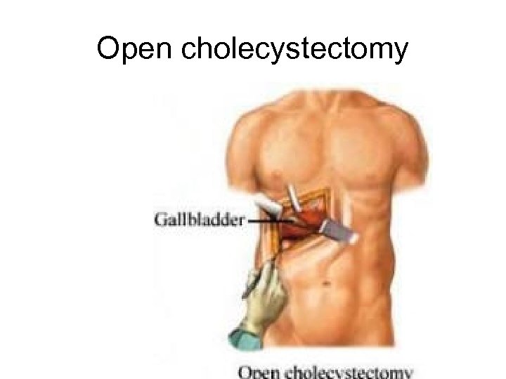 Open cholecystectomy 