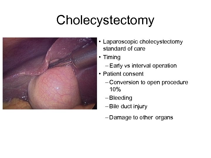 Cholecystectomy • Laparoscopic cholecystectomy standard of care • Timing – Early vs interval operation