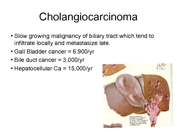 Cholangiocarcinoma • Slow growing malignancy of biliary tract which tend to infiltrate locally and