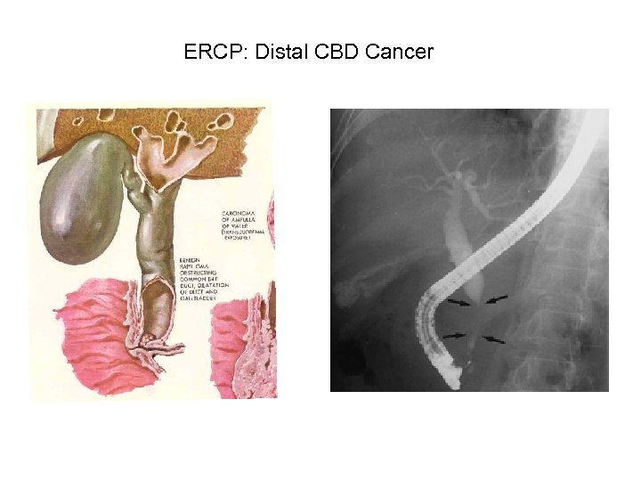 ERCP: Distal CBD Cancer 