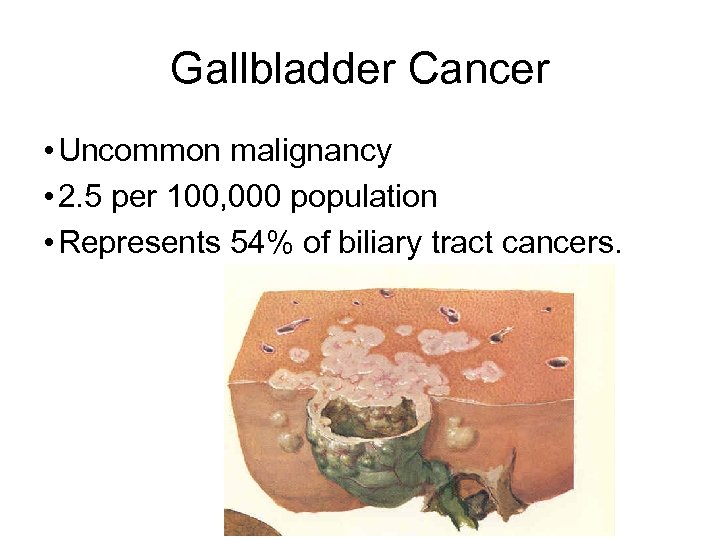 Gallbladder Cancer • Uncommon malignancy • 2. 5 per 100, 000 population • Represents