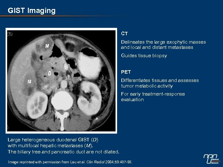 GIST Imaging CT • Delineates the large exophytic masses and local and distant metastases