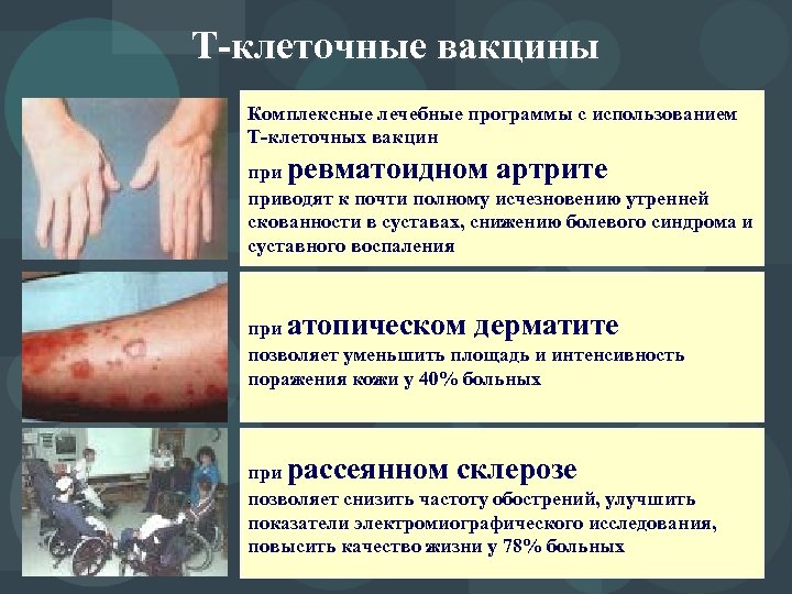Т-клеточные вакцины Комплексные лечебные программы с использованием Т-клеточных вакцин при ревматоидном артрите приводят к