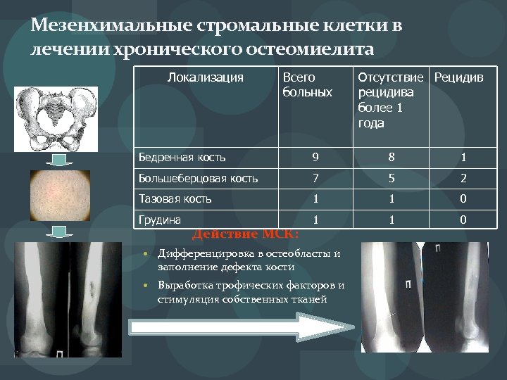 Мезенхимальные стромальные клетки в лечении хронического остеомиелита Локализация Всего больных Отсутствие Рецидив рецидива более
