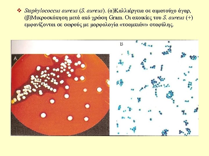 v Staphylococcus aureus (S. aureus). (α)Καλλιέργεια σε αιματούχο άγαρ, (β)Μικροσκόπηση μετά από χρώση Gram.