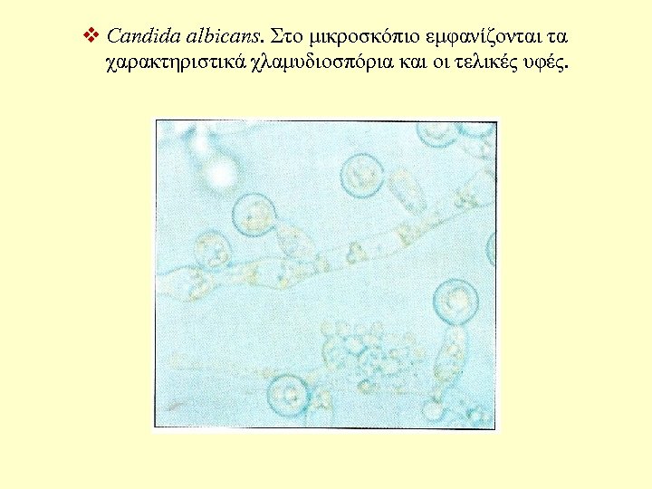 v Candida albicans. Στο μικροσκόπιο εμφανίζονται τα χαρακτηριστικά χλαμυδιοσπόρια και οι τελικές υφές. 