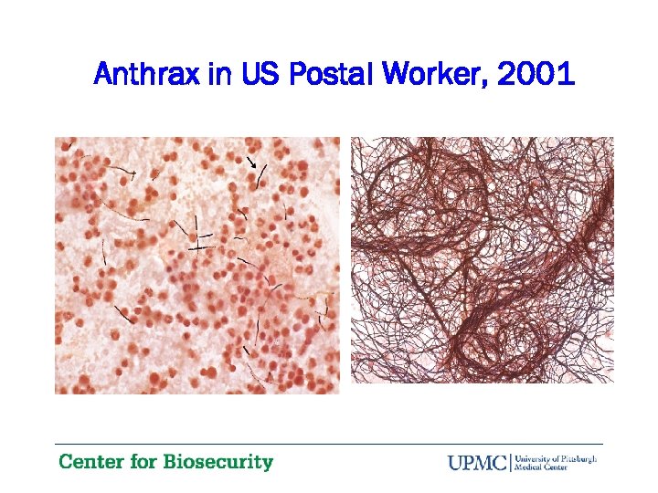 Anthrax in US Postal Worker, 2001 
