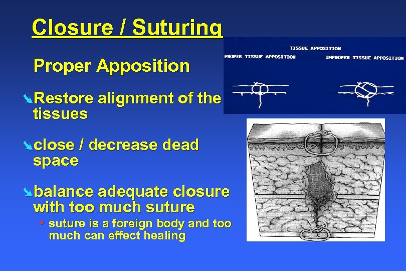 Closure / Suturing Proper Apposition ØRestore alignment of the tissues Øclose / decrease dead