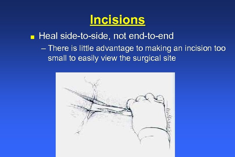 Incisions n Heal side-to-side, not end-to-end – There is little advantage to making an