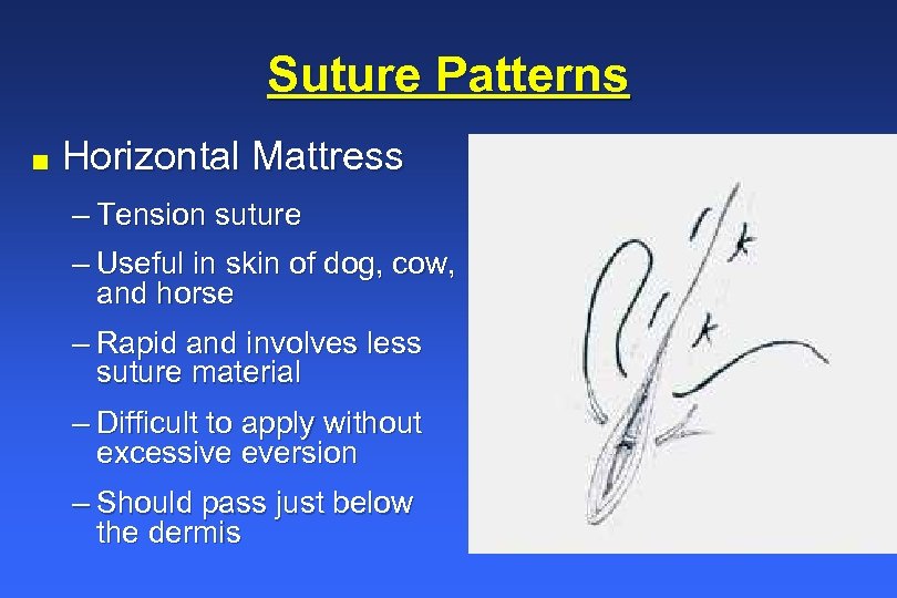 Suture Patterns n Horizontal Mattress – Tension suture – Useful in skin of dog,
