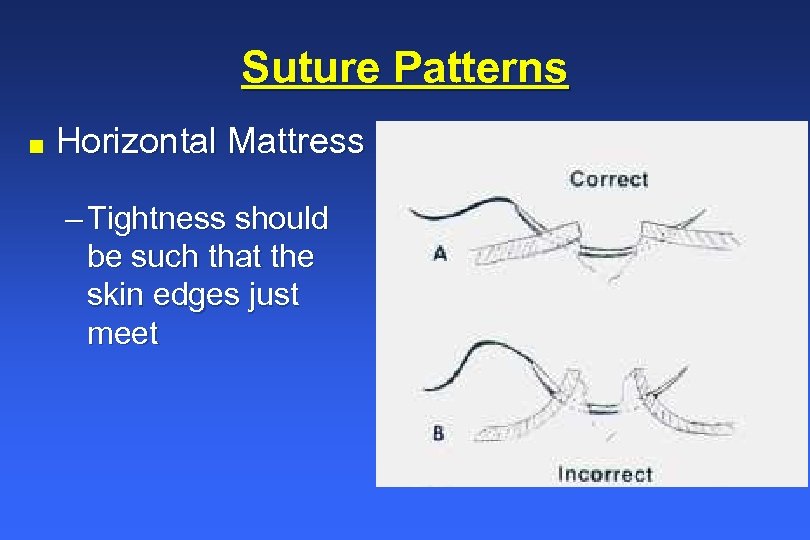 Suture Patterns n Horizontal Mattress – Tightness should be such that the skin edges
