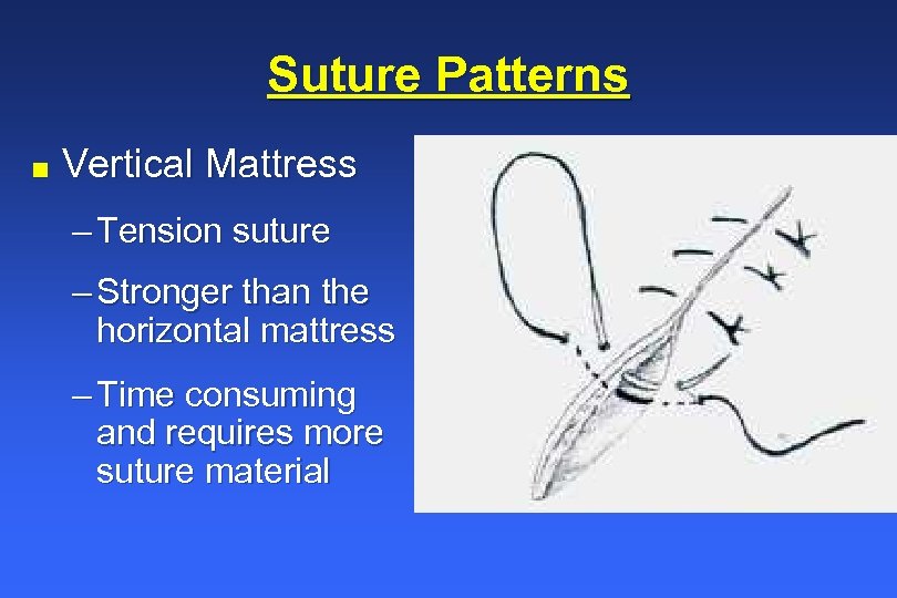 Suture Patterns n Vertical Mattress – Tension suture – Stronger than the horizontal mattress
