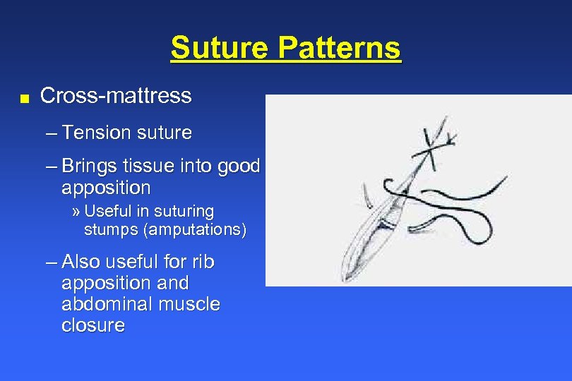 Suture Patterns n Cross-mattress – Tension suture – Brings tissue into good apposition »