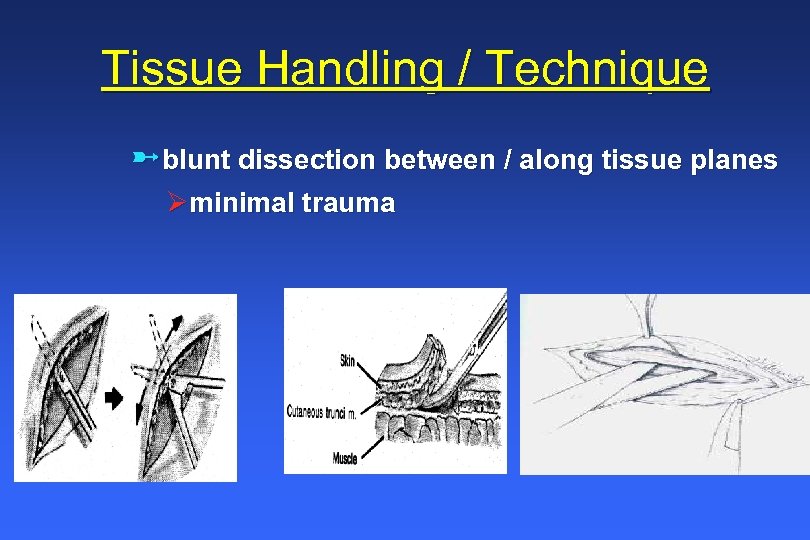 Tissue Handling / Technique üblunt dissection between / along tissue planes Øminimal trauma 