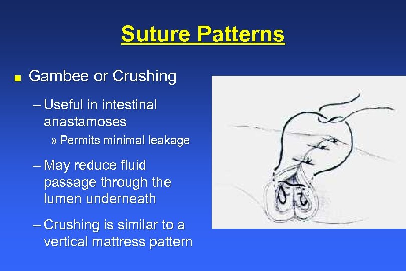 Suture Patterns n Gambee or Crushing – Useful in intestinal anastamoses » Permits minimal