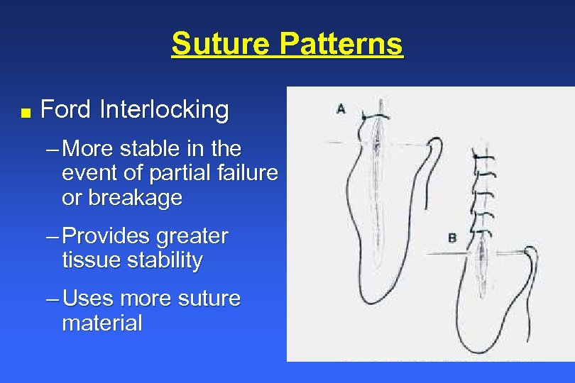 Suture Patterns n Ford Interlocking – More stable in the event of partial failure