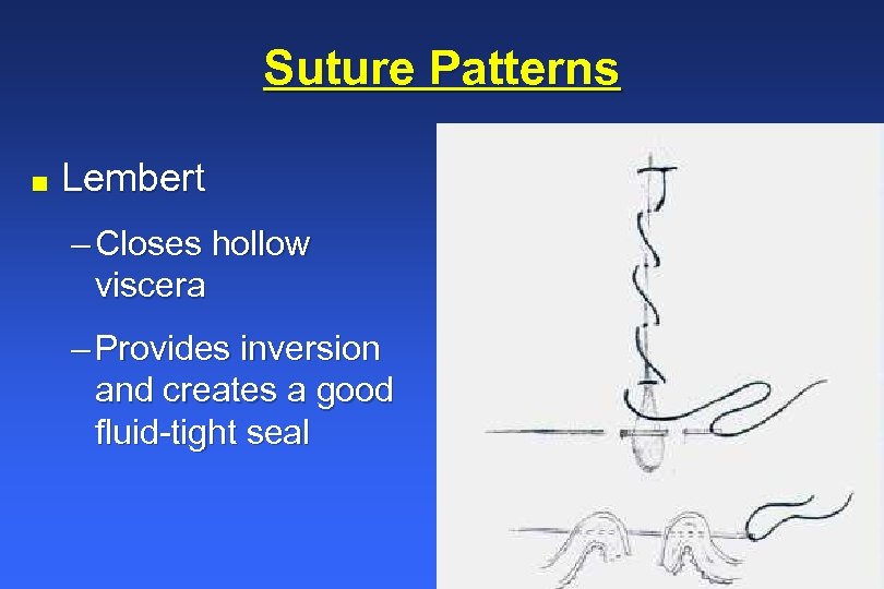 Suture Patterns n Lembert – Closes hollow viscera – Provides inversion and creates a