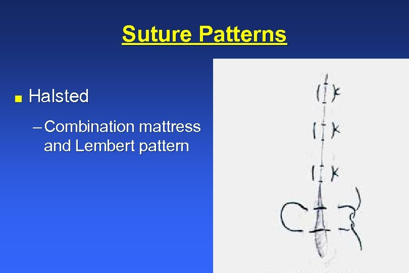 Suture Patterns n Halsted – Combination mattress and Lembert pattern 