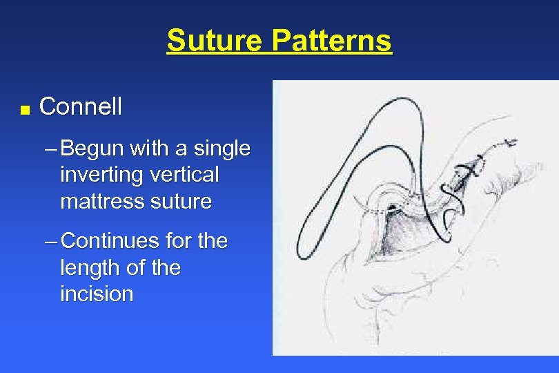 Suture Patterns n Connell – Begun with a single inverting vertical mattress suture –
