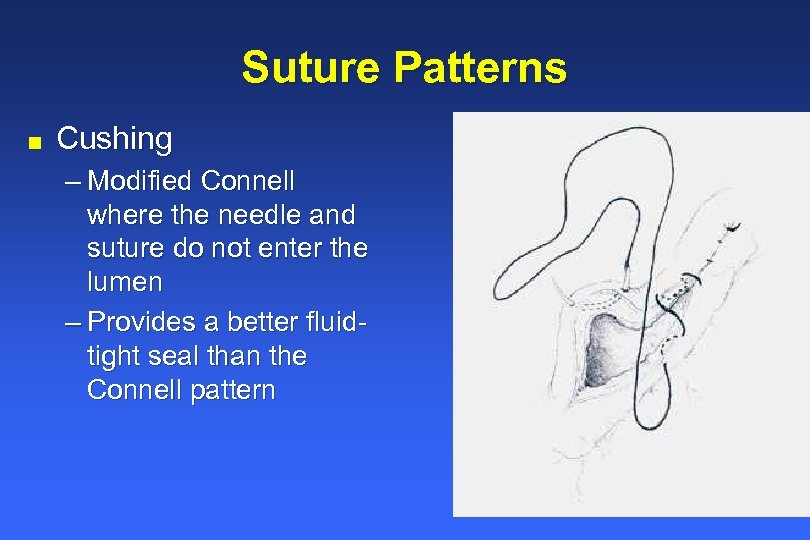 Suture Patterns n Cushing – Modified Connell where the needle and suture do not