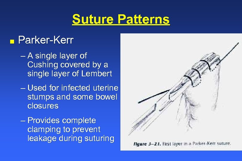 Suture Patterns n Parker-Kerr – A single layer of Cushing covered by a single
