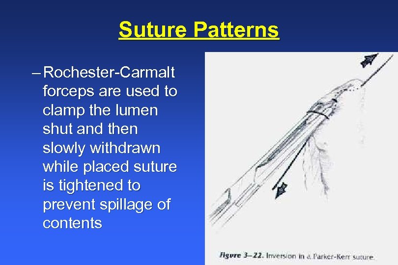 Suture Patterns – Rochester-Carmalt forceps are used to clamp the lumen shut and then