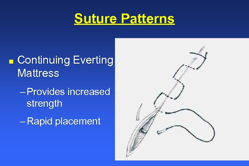 Suture Patterns n Continuing Everting Mattress – Provides increased strength – Rapid placement 