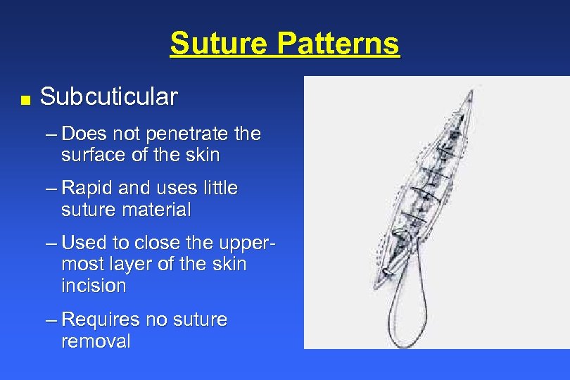Suture Patterns n Subcuticular – Does not penetrate the surface of the skin –
