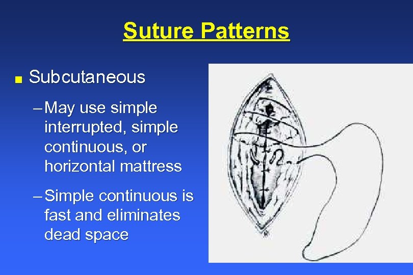 Suture Patterns n Subcutaneous – May use simple interrupted, simple continuous, or horizontal mattress