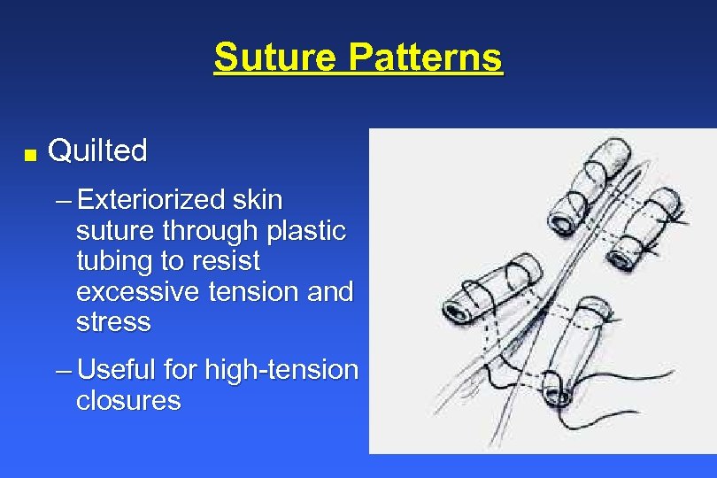 Suture Patterns n Quilted – Exteriorized skin suture through plastic tubing to resist excessive