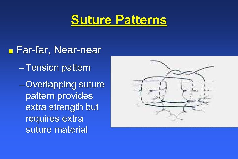 Suture Patterns n Far-far, Near-near – Tension pattern – Overlapping suture pattern provides extra