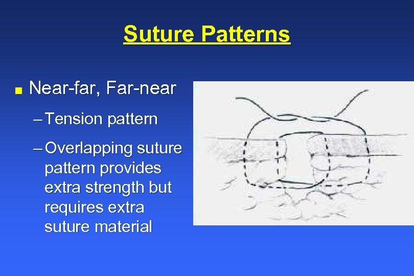 Suture Patterns n Near-far, Far-near – Tension pattern – Overlapping suture pattern provides extra