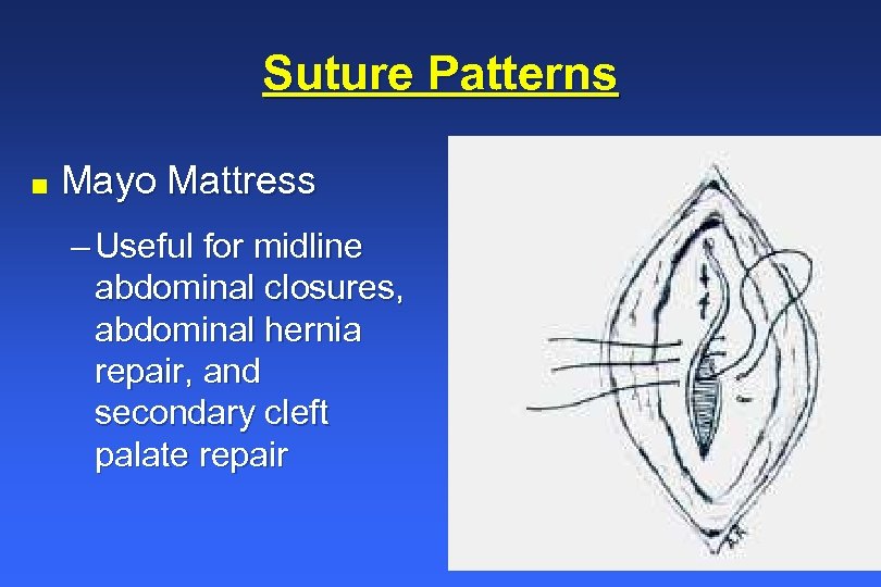 Suture Patterns n Mayo Mattress – Useful for midline abdominal closures, abdominal hernia repair,