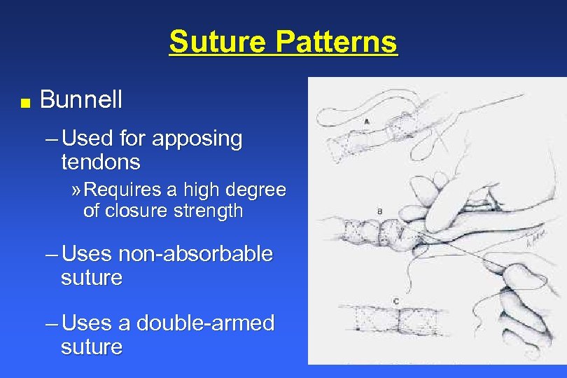 Suture Patterns n Bunnell – Used for apposing tendons » Requires a high degree