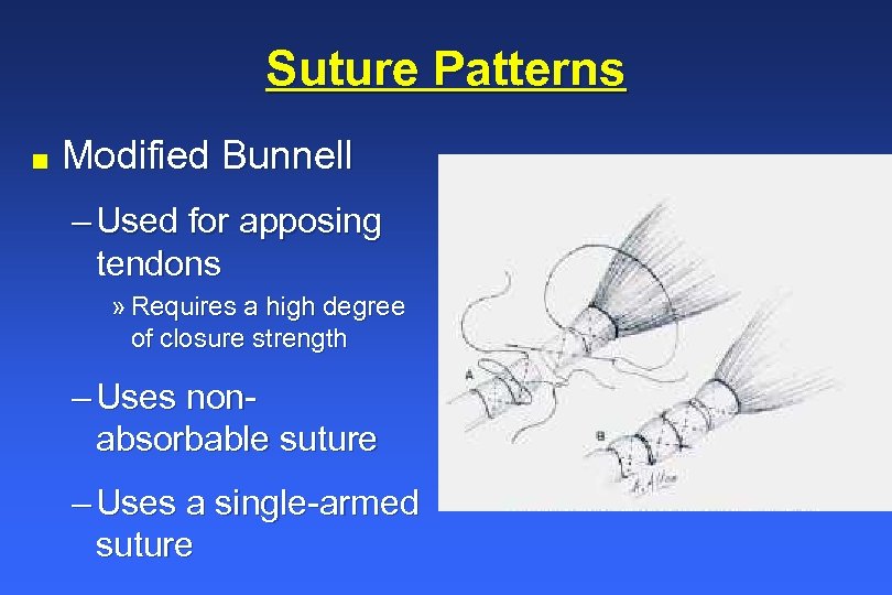 Suture Patterns n Modified Bunnell – Used for apposing tendons » Requires a high