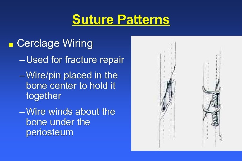 Suture Patterns n Cerclage Wiring – Used for fracture repair – Wire/pin placed in